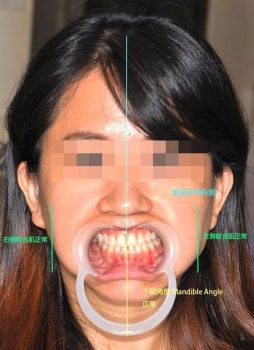 顳顎關節偏移-治療後2-顳顎關節症候群Neuromuscular-Disorder-張智洋醫師small-254x350